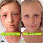 Raw Food Skin Before And After Transformation (With Photos)