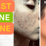 Yeast Acne Treatment: Acne Transformation In Just 8 Weeks!